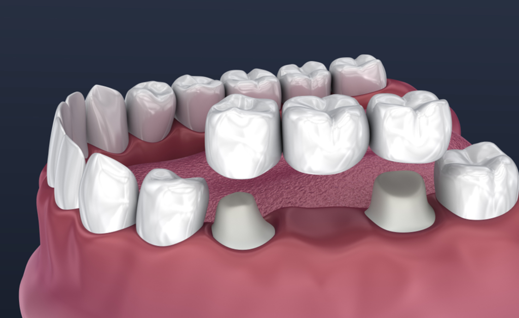 What Are The Roles Of Crowns And Bridges Twilight Dental Center